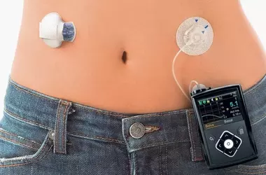 Insulin Pumps: A Comprehensive Guide to Understanding Continuous Insulin Delivery Systems